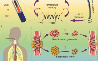 Adv. Mater：在温度记忆螺旋管中封装放射性核素以构建功能性支架治疗食管癌的恶性狭窄