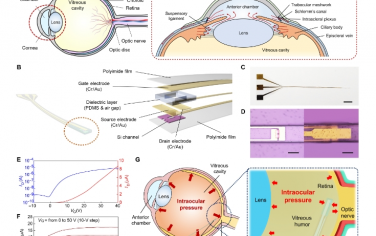 Science Advances：实时活体监测前房和玻璃体房眼压分布以诊断青光眼