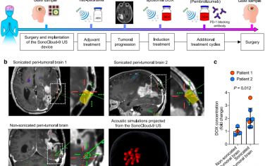 Nat. Commun：超声介导的阿霉素脑部递送可实现免疫调节和改善胶质瘤患者对PD-1阻断的应答