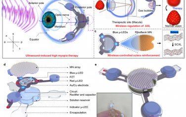 Nat. Commun：无线无电池的眼调节贴片用于治疗高度近视