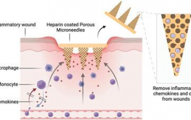 AFM：海绵状微针空间隔离趋化因子并消耗单核细胞以缓解炎症性皮肤病